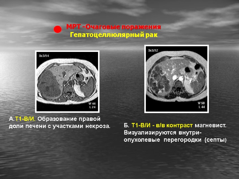МРТ -Очаговые поражения Гепатоцеллюлярный рак Б. Т1-В/И - в/в контраст магневист. Визуализируются внутри-опухолевые 